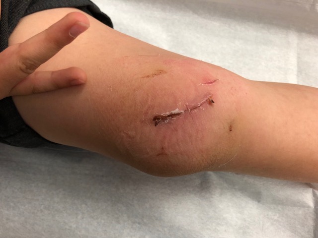The gash on Henry’s knee caused by a buried object.